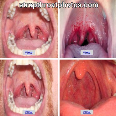 how to tell if cold or strep