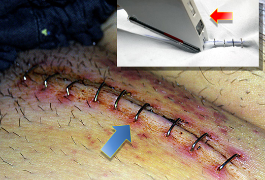 how to tell if a self harm cut is infected