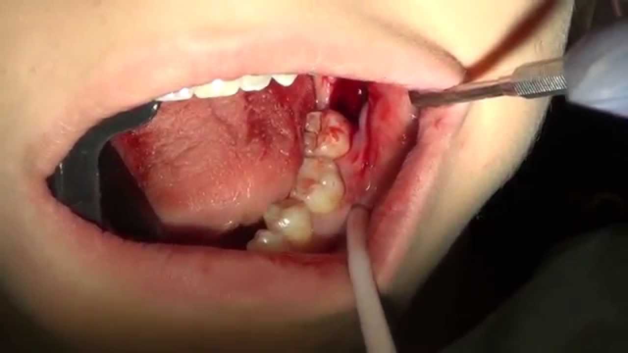 wisdom tooth pain how to stop it