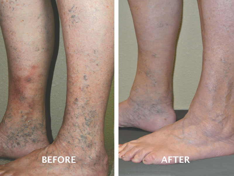 how to work with varicose veins
