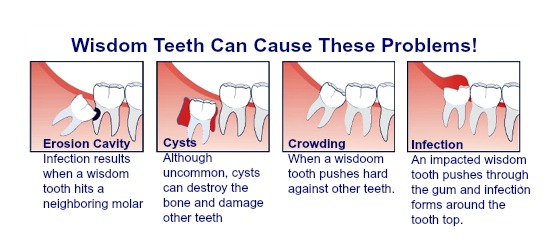 wisdom tooth pain how to stop it